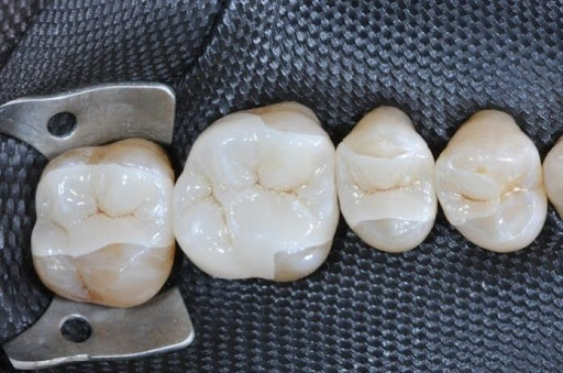 индиректни реставрации